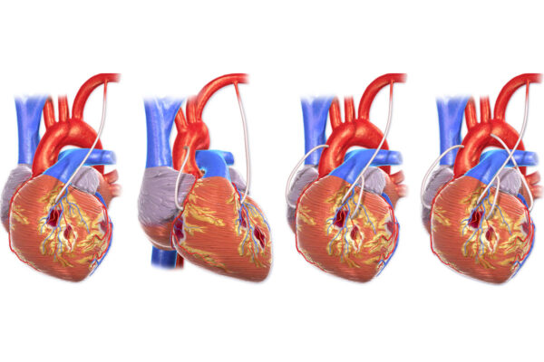 Operacja pomostowania aortalno-wieńcowego